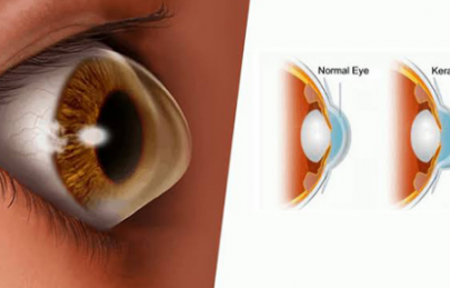 GIÁC MẠC HÌNH CHÓP - TRIỆU CHỨNG, NGUYÊN NHÂN VÀ ĐIỀU TRỊ